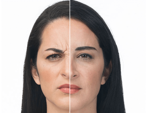 How Long Does Botox® Last?