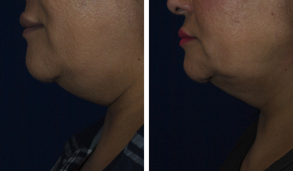 Kybella Before & After Rockwall, TX