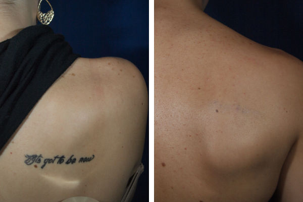 Laser Tattoo Removal Rockwall & Dallas | Juvanew Medspa