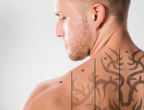 Is Laser Tattoo Removal Painful?