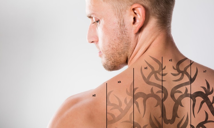 Is Laser Tattoo Removal Painful? | Rockwall Laser Tattoo Removal | Juvanew  Medspa