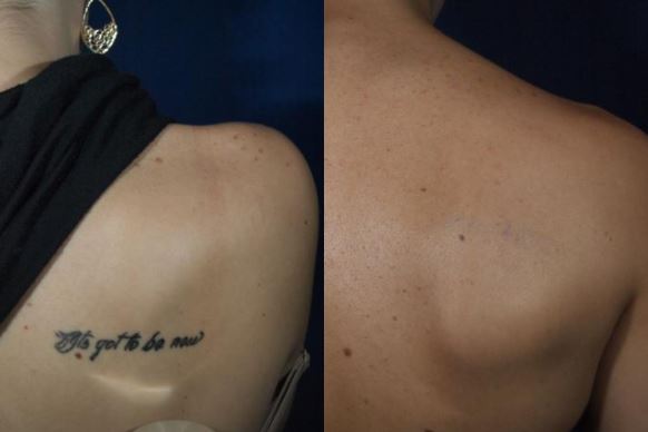 How Does Laser Tattoo Removal Work? | Rockwall Laser Tattoo Removal |  Juvanew Medspa
