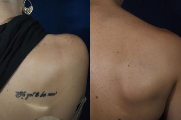 Am I a Candidate for Laser Tattoo Removal? | Rockwall Laser Tattoo Removal  | Juvanew Medspa